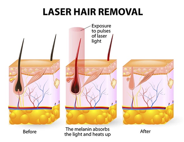 Laser Treatment comparision