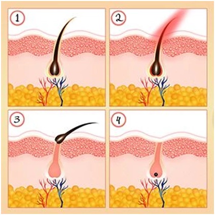 Laser Treatment comparision