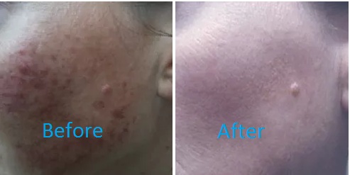 Laser Treatment comparision